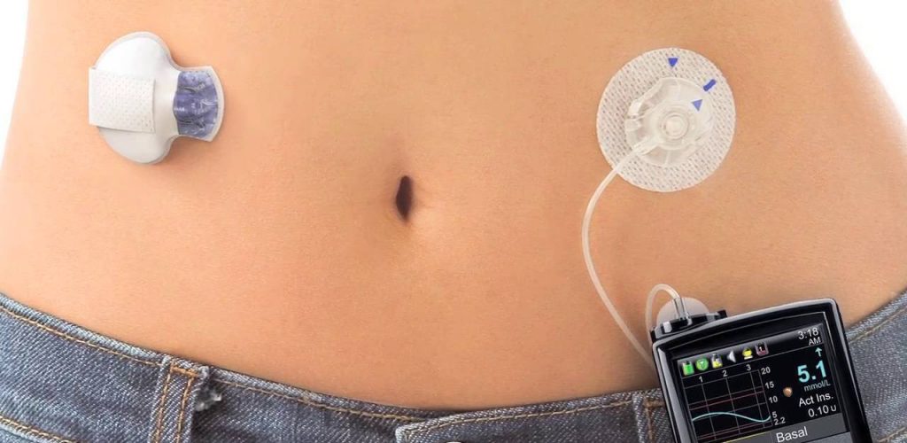 Epic 4 Health Blog | Artificial Pancreas for Diabetes